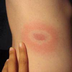 Foto von Erythema migrans